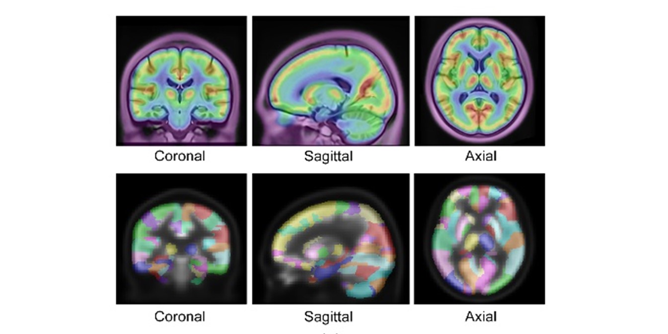 图1. 中国人群的脑部PET影像平均图谱